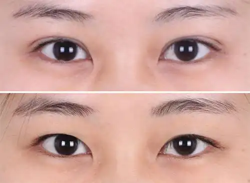 韩国soonplus双眼皮变单手术案例前后对比照片