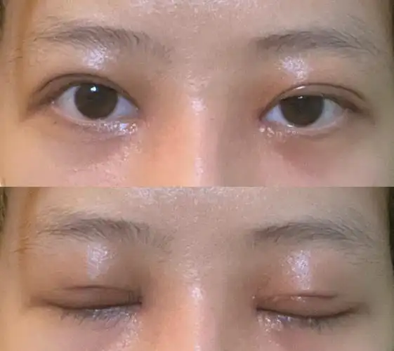 看看我双眼皮提肌是不是失败了(福州协和谢义德)