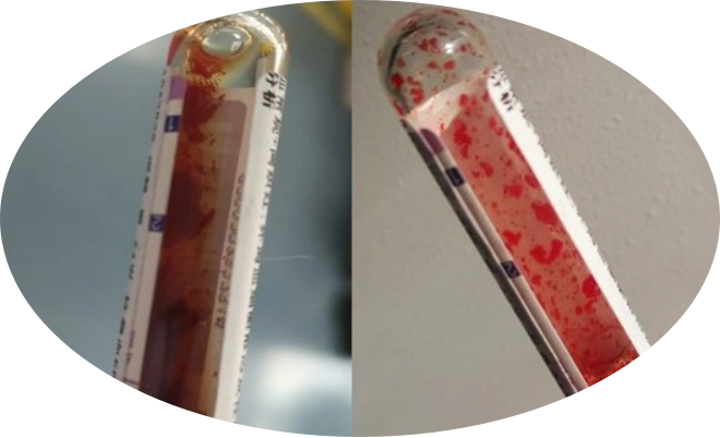 一例红细胞冷凝集导致血常规计数偏差