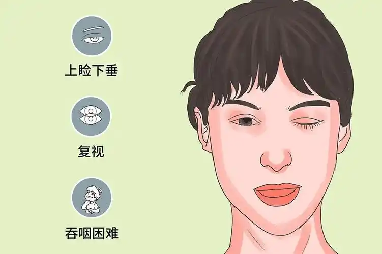 医生:这种罕见病离你并不遥远|神经内科|罕见病|肌无力|患者|症状