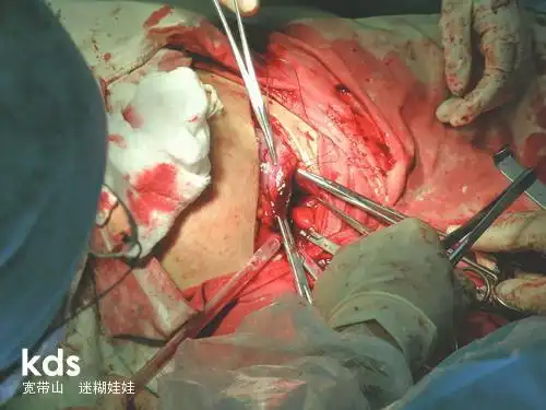 顺产破腹产全过程,男人们请珍惜为你生孩子的那个女人_kds宽带山