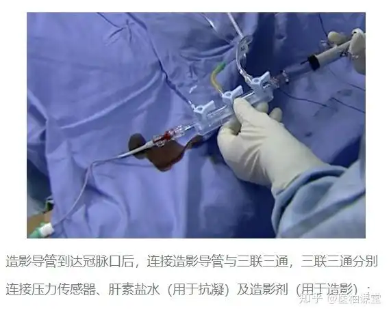 心脏支架(stent)又称冠状动脉支架,是心脏介入手术中常用的医疗器械