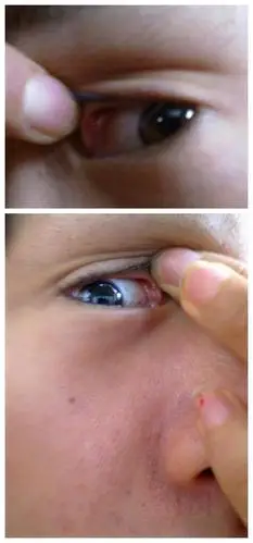 上眼睑内靠近眼角处有白色物体,好久未下去,痒各眼睛,怎么回事?