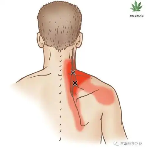肩胛提肌功能解剖触诊手法治疗