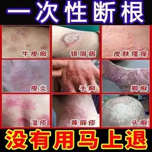 发】达力士 卡泊三醇软膏 15g*1支/盒 寻常型银屑病 外用牛皮癣药膏