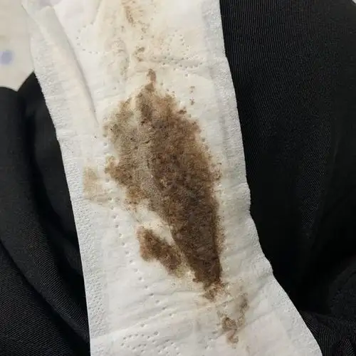 孕早期有褐色血