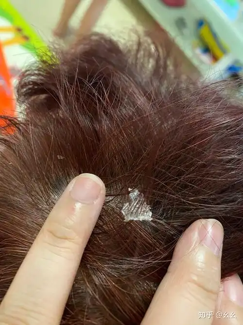 见过的最大头皮屑多大