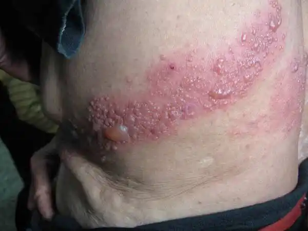 避免对周围皮肤感染,尽量不要和他人亲密接触,防止病毒的传播