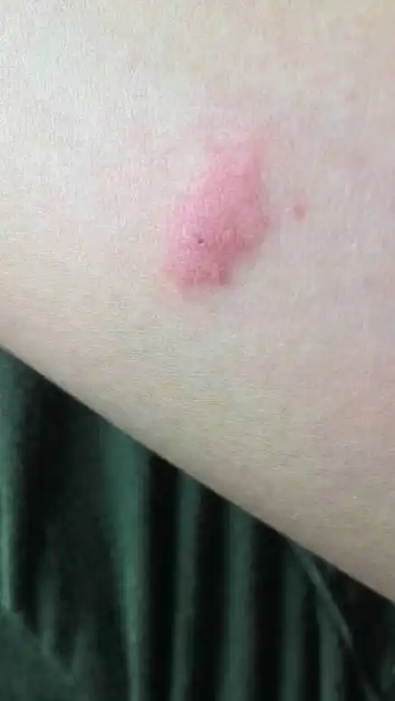 是因为水土不服吗?这是湿疹吗?每个包上都有个小