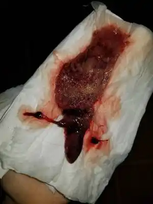 请问是流产了吗?