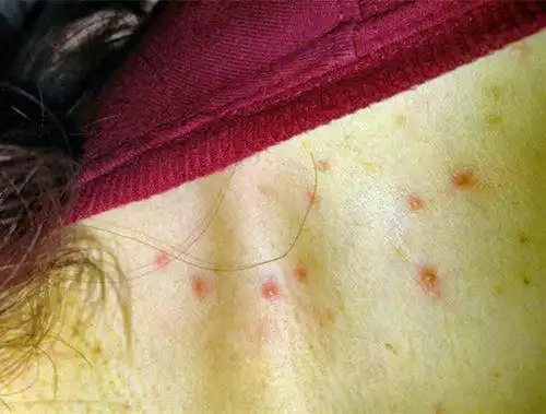 为什么有些人前胸和后背也会长痘痘记好这点就不用大惊小怪