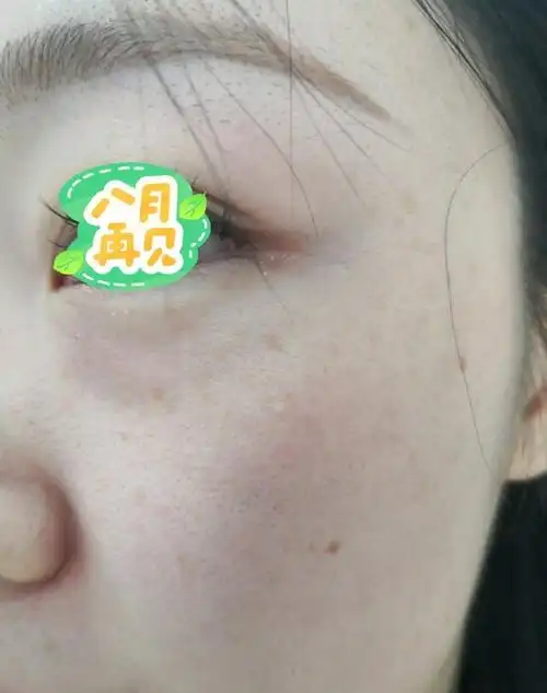 一条plog告别八月##色素痣##解决皮肤问题专注皮肤美容