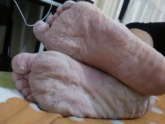 朋友脚一到冬天就这样还很臭很痒是怎么回去啊啊啊啊啊有时候还很