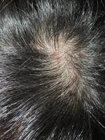 你们头皮有没有这样,小红书上有博主发说是头皮毛囊炎,有点担心[笑哭r