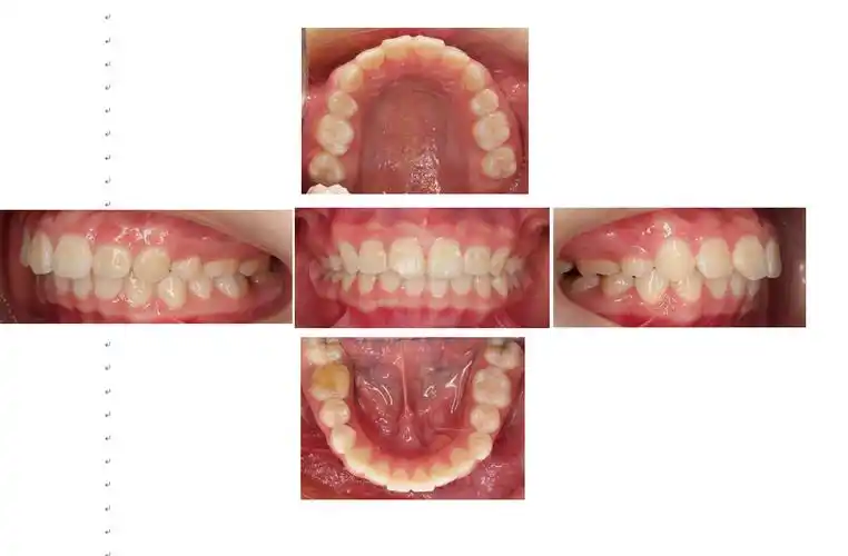 拔除上颌两颗双尖牙改善开唇露齿
