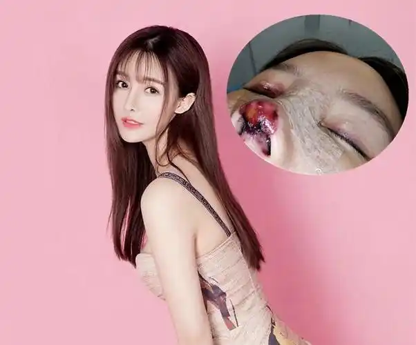 31岁女演员整容失败遭毁容,美梦破碎还失去工作,院方回应了