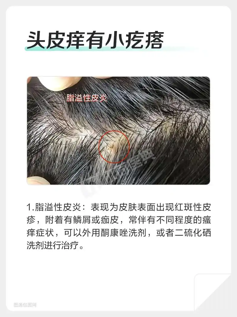 很多朋友们都出现过头皮问题.对于头皮 - 抖音