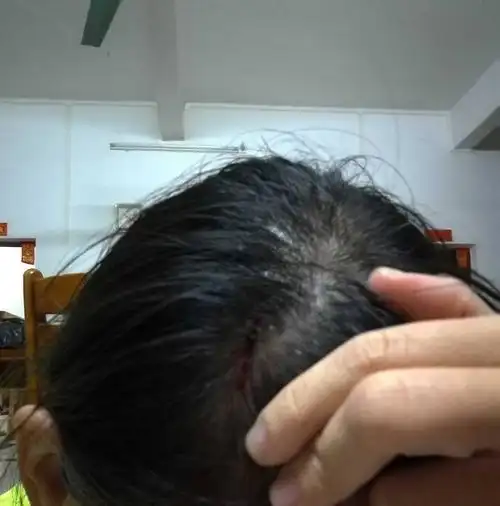 头被撞伤流血要不要去医院检查,缝针打破伤风针?