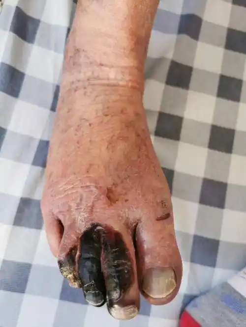 脚趾接连发黑竟是血管拥堵延误治疗可截肢致残