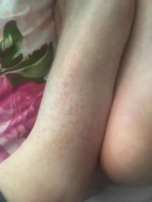 脚上有许多的红点一到冬天就出现夏天就没了这个状况持续有三四