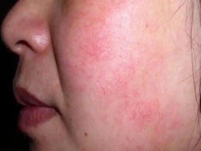 脸上出现红血丝该怎么办?