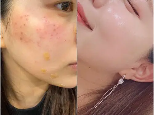 去痘印脸上没有痘痘痘印!甄颜做的疤痕还有微针效果实在太好了!