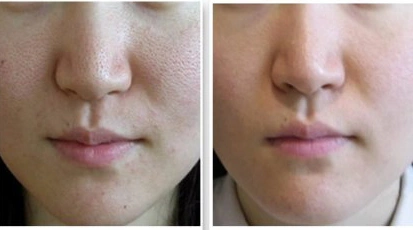 皮肤暗黄毛孔粗大,水光针可以改善吗