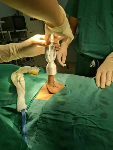 定南中医院为男性朋友解除烦恼,包皮手术只要5分钟,无出血无副作用