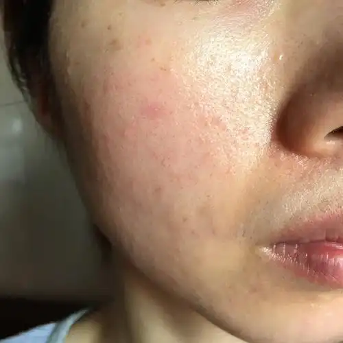 你好李医生是这样的本来属于血热类型青春期开始就比较容