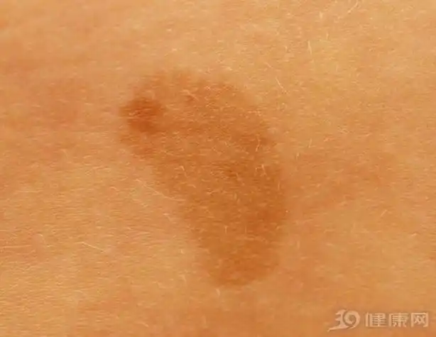 15岁长咖啡斑 还会随着年龄的增长而越来越大,最大直径可达15mm;而