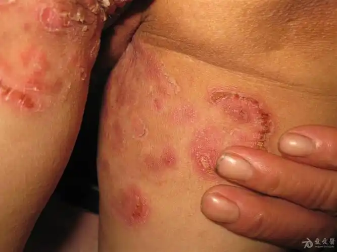 这是什么皮肤病股癣