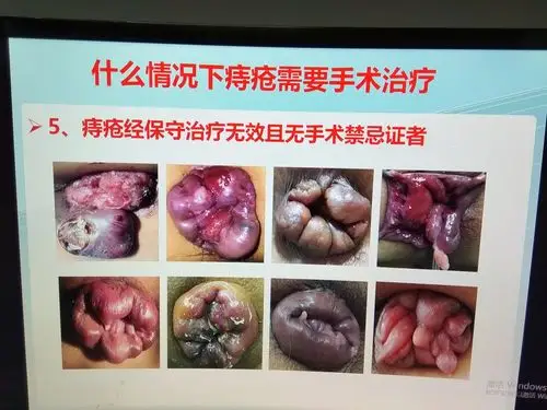 带你认识痔疮什么情况下需要手术治疗?_痔疮_痔疮治疗方式 - 好大夫在