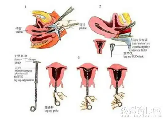 上环痛吗不宜上环的四种情况请谨记3