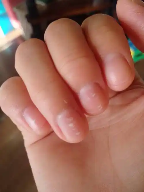 指甲上长这个白点是什么意思 是缺什么还是身体出现了问题?