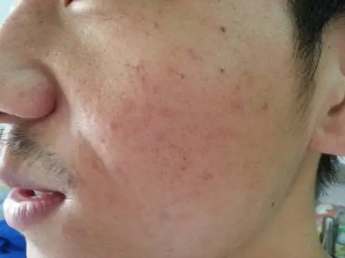 毛孔粗大而且很多坑坑洼洼的,面部发红,毛孔里面很多油脂,求高人指点