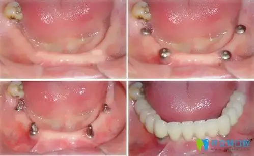 即刻种植和普通种植牙区别在哪教你远离即刻种植牙的误区