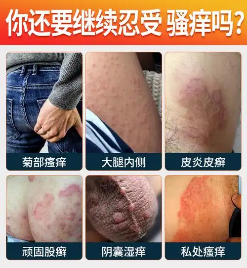 百草皮肤外阴瘙痒止痒膏男女性私处阴囊潮湿抑菌肛门霉