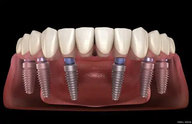 四颗种植体恢复半口缺牙?种植牙究竟种一颗得几个?