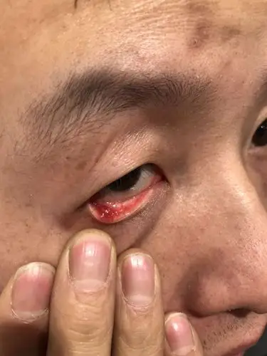 眼睛下眼皮长了一个小疙瘩