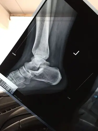 外科医生帮我看看脚的片子