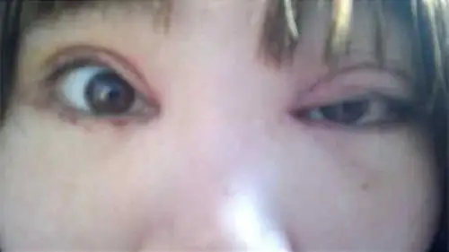 小丽(化名)是我们采访的一位双眼皮手术失败的女生,以下是我们的聊天