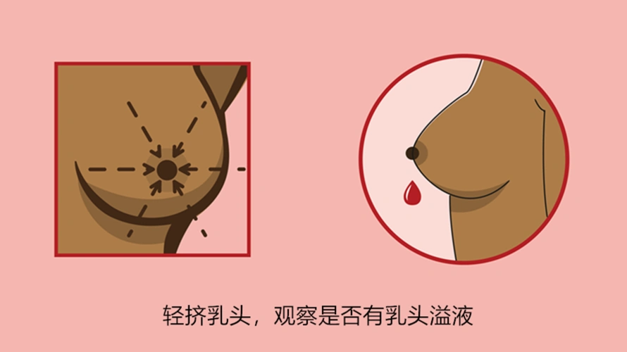 挤:用食指和拇指轻轻挤乳头,看看乳头没有液体出现.