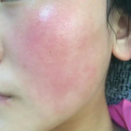 脸永远都是红红的红血丝还好不怎么明显