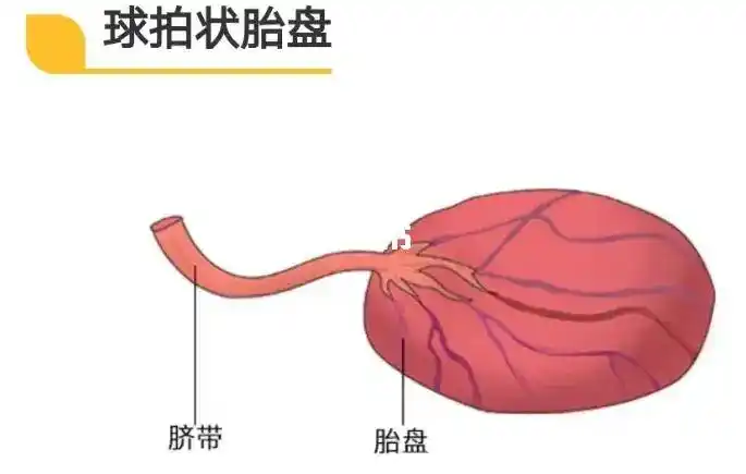 nt数值正常,但胎盘和脐带异常了01