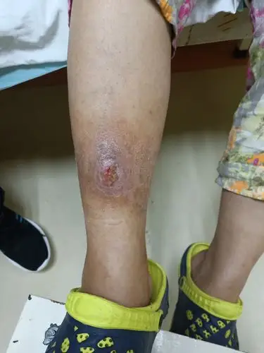 一慢疮患者恢复情况