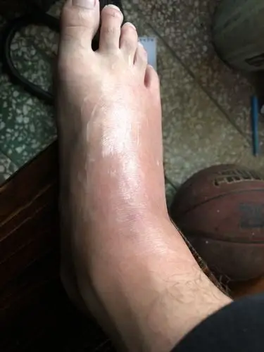 被飞虫咬到脚,红肿痒怎么办?