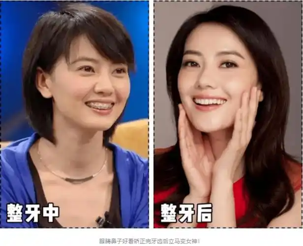 比如高圆圆之前就有做过,矫正之后立马女神?