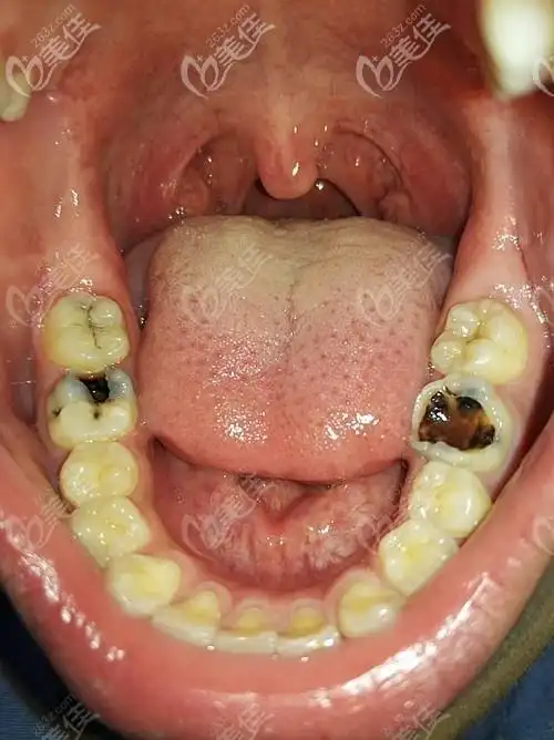第二磨牙成了龋齿都已经烂空了是该拔掉还是补一补就可以了
