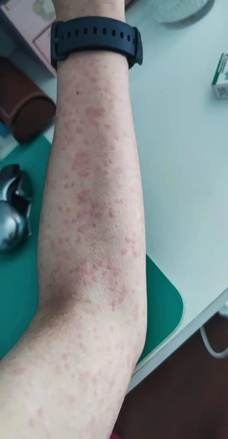 新冠感染全身皮肤红疹 不是过敏.2022年12月22日应该被 - 抖音