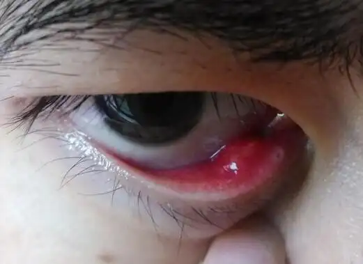 照片上看不出上面的小脓包,先前翻眼睑对镜子看还将最里面的一个小